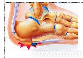 Chứng đau gót chân cách phòng chữa